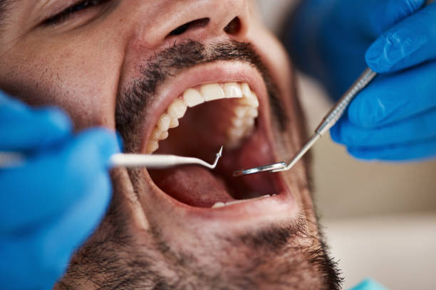 Best Emergency Wisdom Tooth Extraction in Greenfield, MO